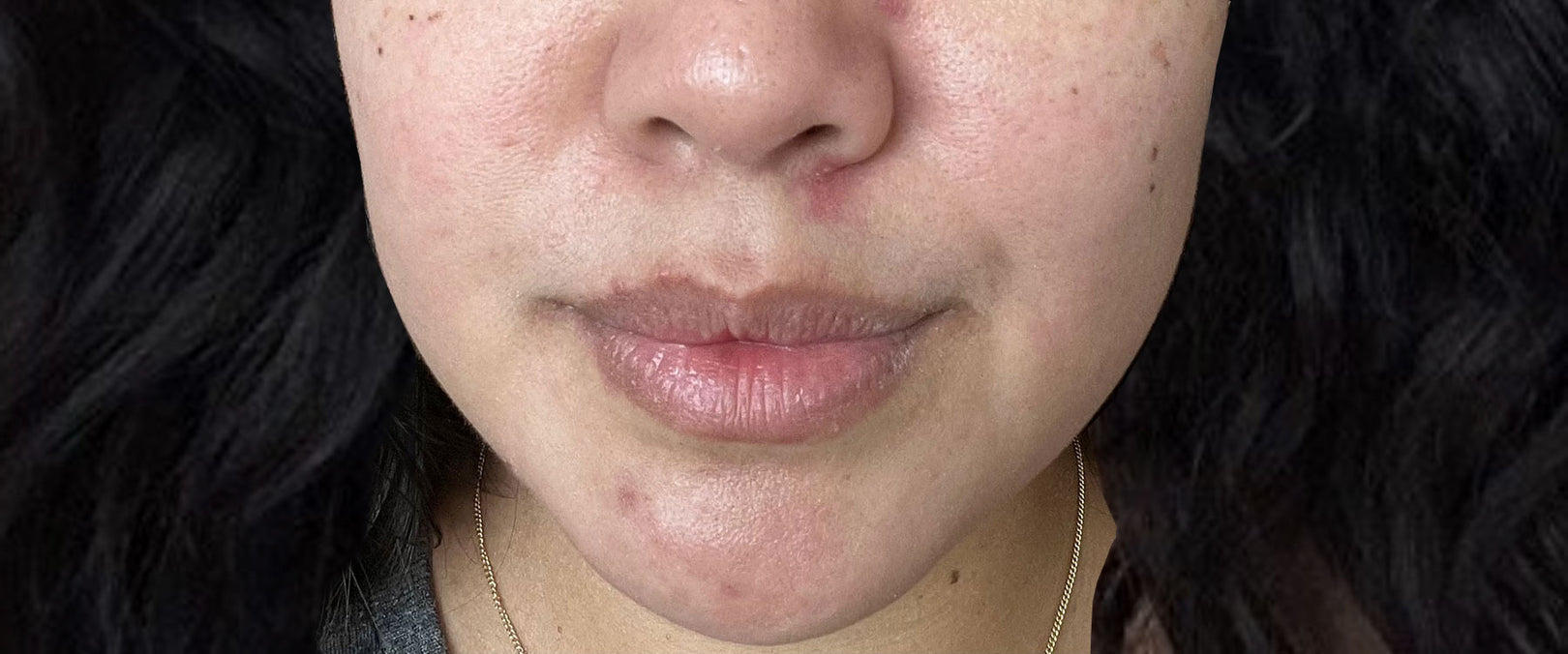Image of woman with blemishes before using Plantkos products