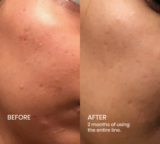 Image of Plantkos Phyto Triple C Serum before and after