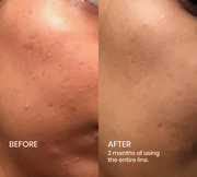 Image of Plantkos Phyto Exfoliating Cleanser before and after helps control blemishes